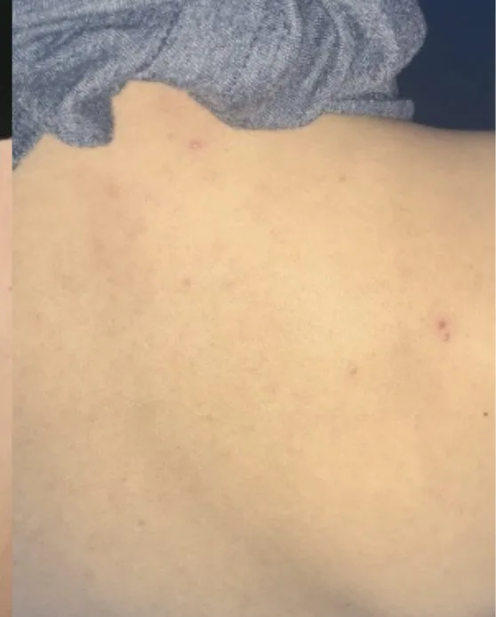 Laser tattoo removal after: fine-line script, real EradiTatt patient