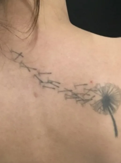 Laser tattoo removal before: fine-line script, real EradiTatt patient