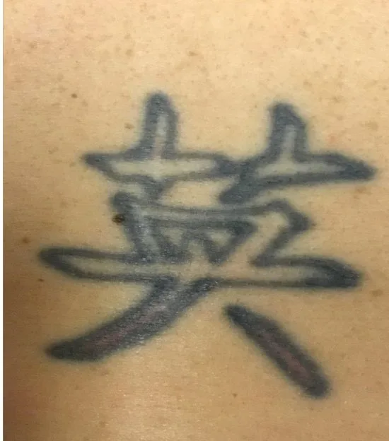 Laser tattoo removal before: black ink shoulder tattoo, real EradiTatt patient